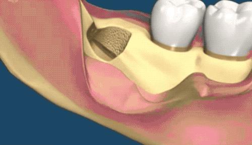 拔智齿的全过程科普,拔智齿细致操作过程