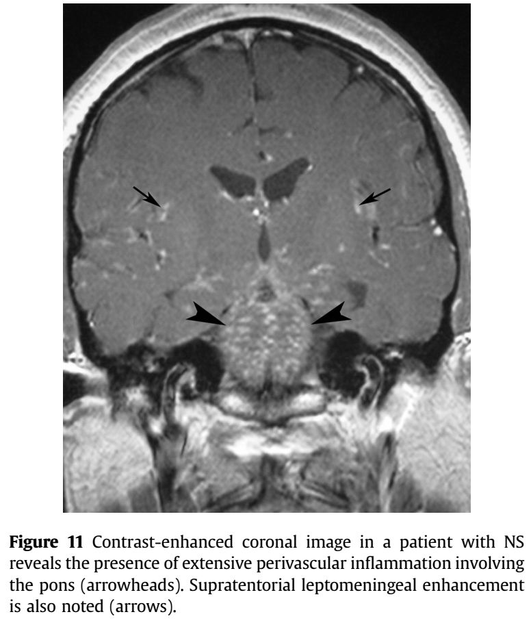 Whipple病、纹状体手、神经结节病、脱髓鞘假瘤丨3分钟读片·第16期