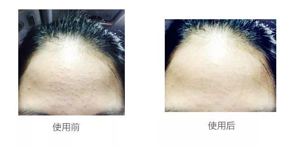 哪个牌子的壬二酸凝胶好,首博尔壬二酸清痘凝胶副作用