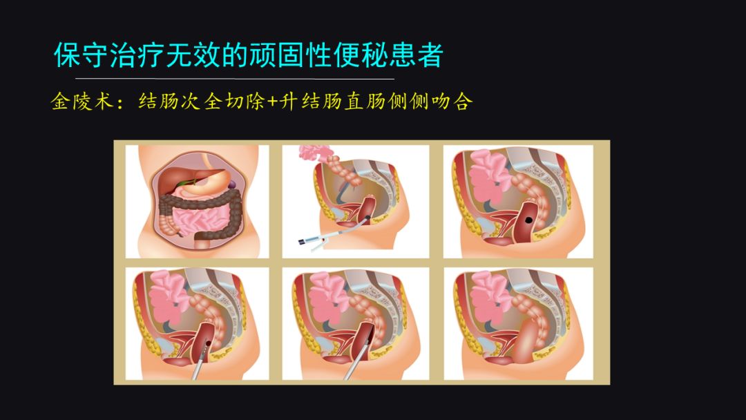 李宁奋斗历程英文版,李宁夜以继日