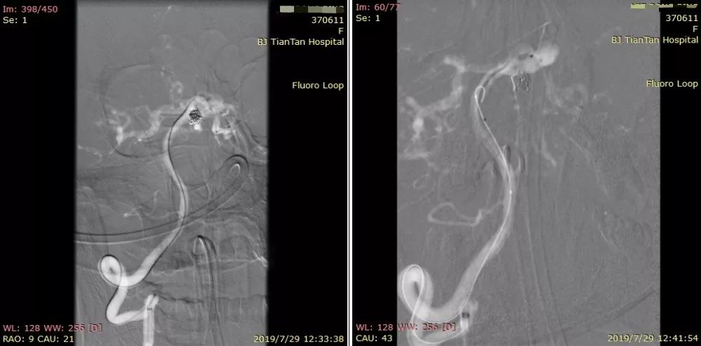 物华天宝·第12期｜复发多发动脉瘤合并烟雾病的支架辅助弹簧圈栓塞治疗