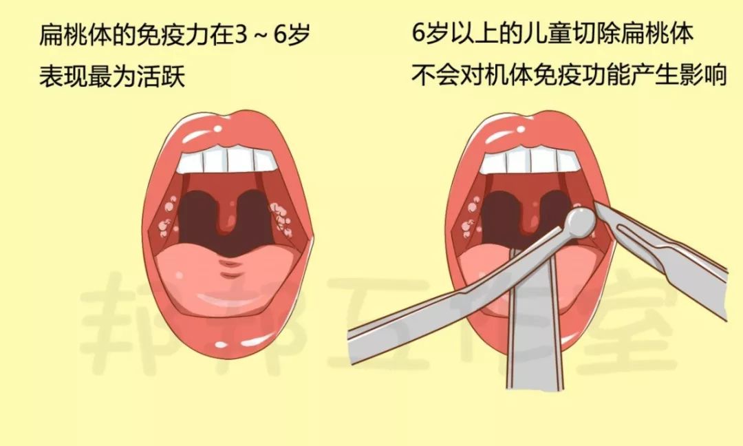 割了扁桃体就不会喉咙发炎了吗,割了扁桃体会变傻吗