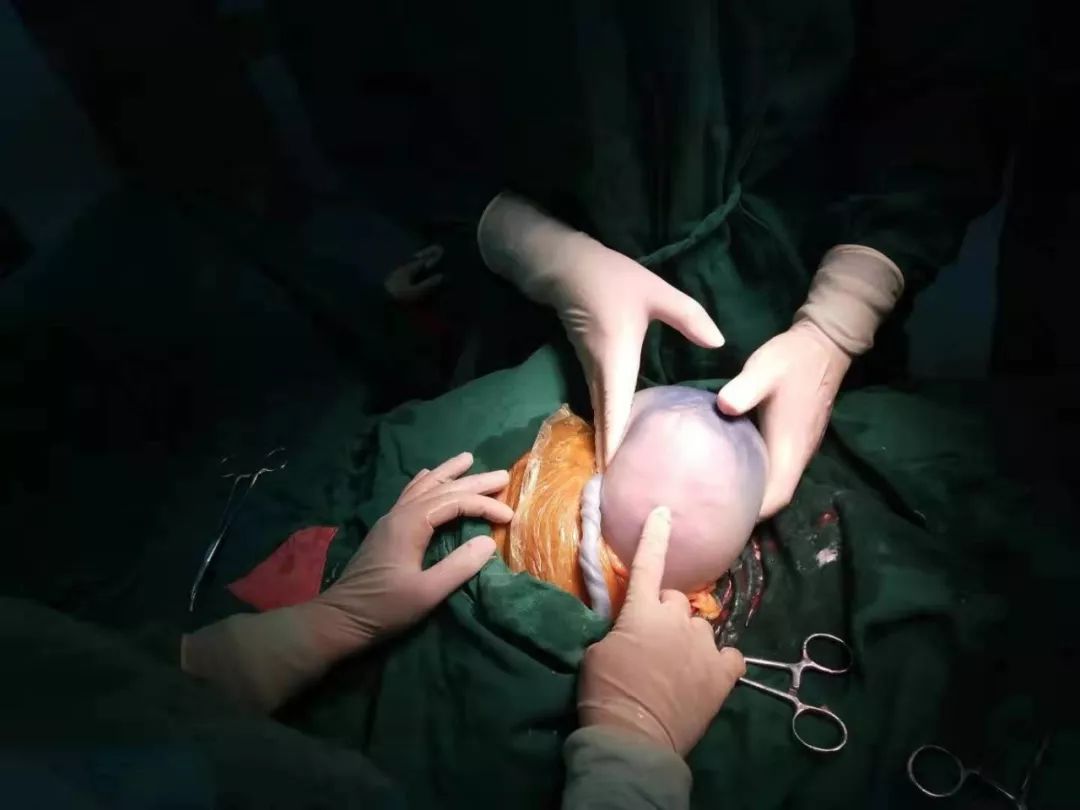 36岁的孕妇产下一“透明蛋”，里面的男宝宝还在动