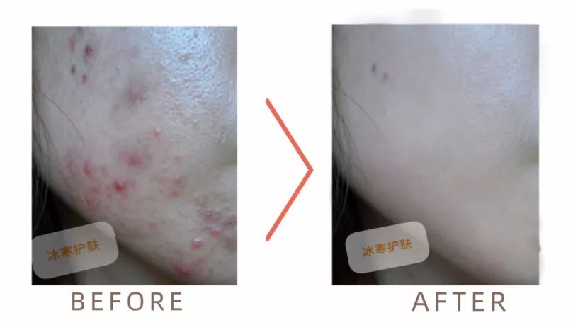 一支药膏全搞定,一支药膏搞定所有痘痘