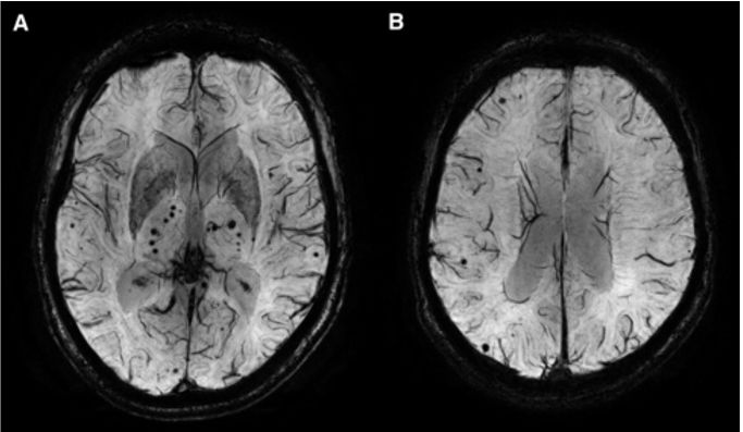 脑出血的科普知识文章,关于脑出血综述