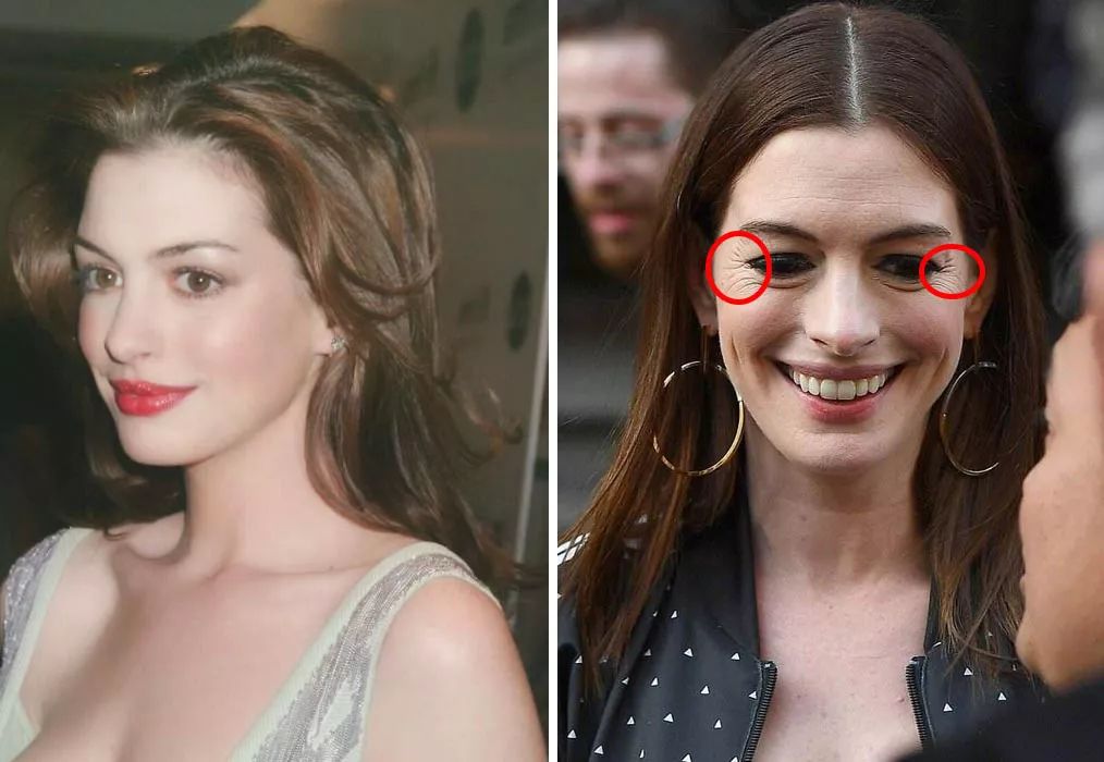 法令纹眼纹一个都逃不掉,法令纹和眼纹怎么才能有效改善