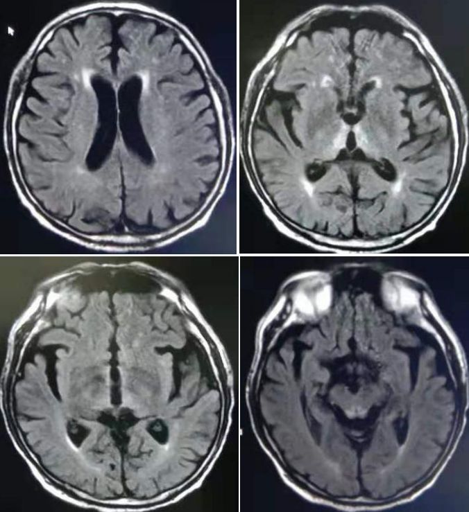 矛盾反应、Carney综合征、脑梗死、笑气中毒丨3分钟读片·第19期
