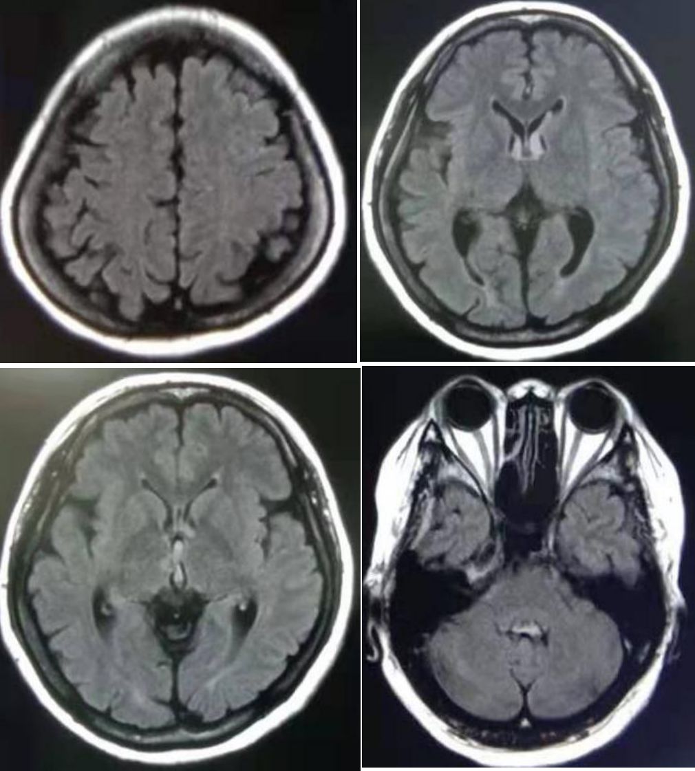 矛盾反应、Carney综合征、脑梗死、笑气中毒丨3分钟读片·第19期