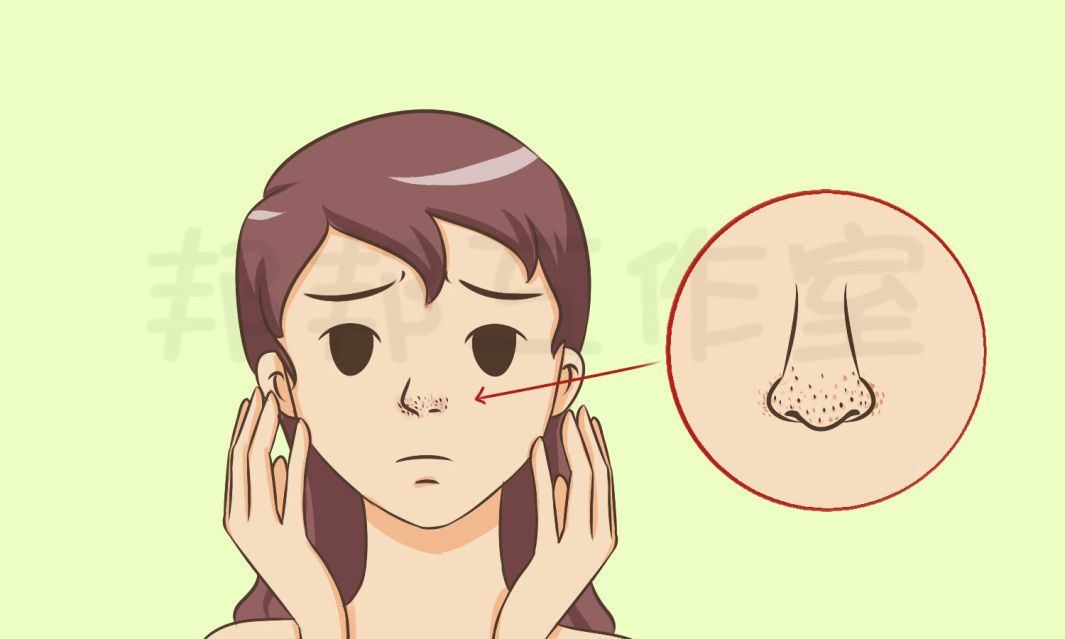 长黑头粉刺该怎么快速去除,鼻子上的黑头特别多该怎么去除