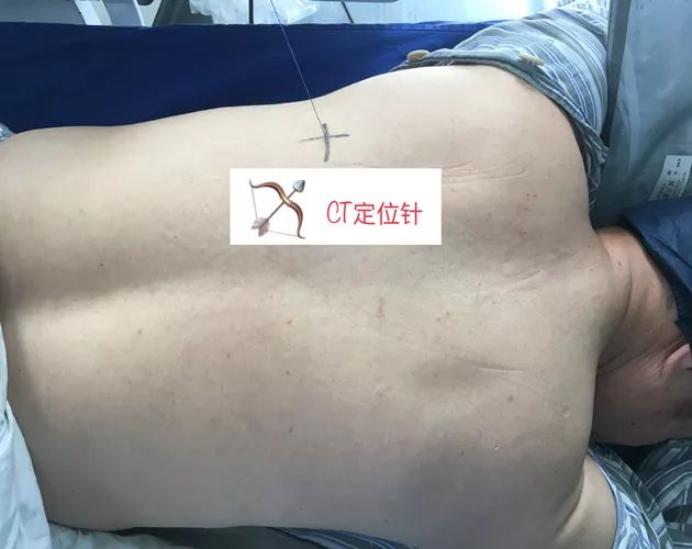 胸椎旁神经阻滞时需要穿过的韧带,胸椎旁神经阻滞超声探头位置