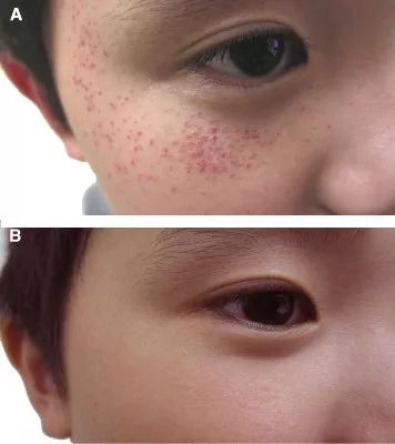 4岁小孩练倒立有影响吗,孩子练习倒立脸有淤血怎么办