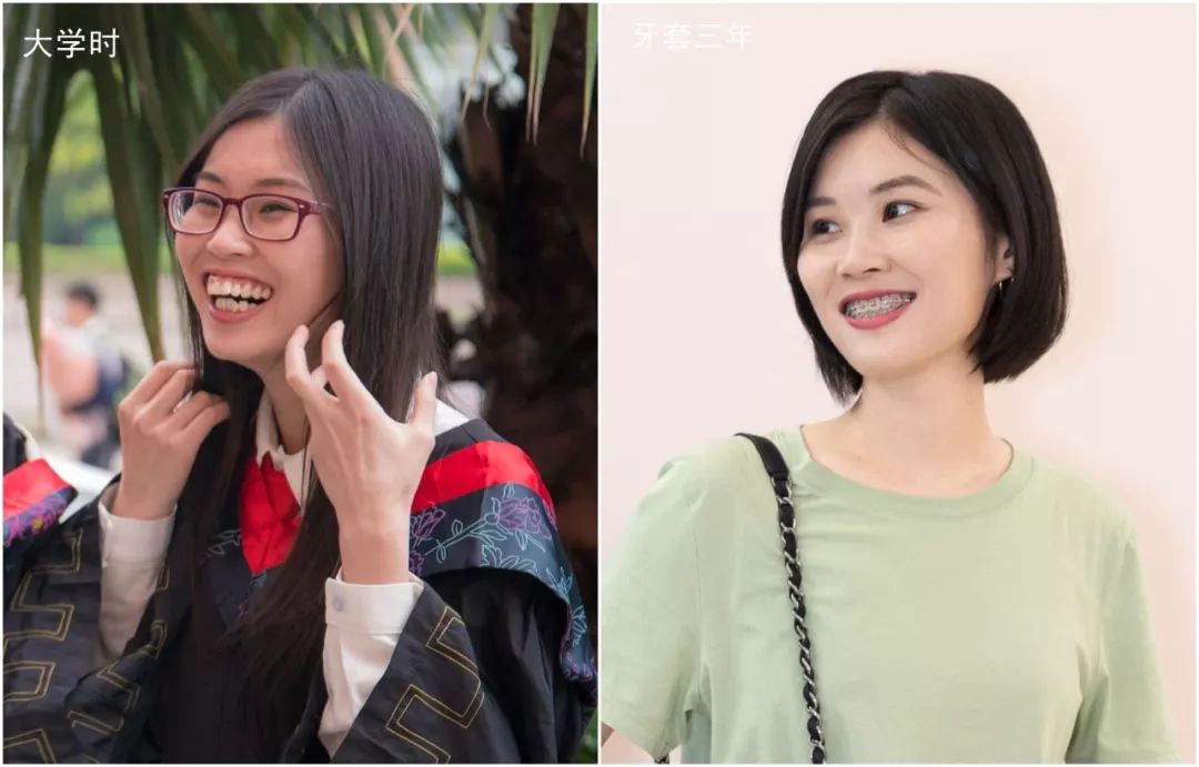 摘掉牙套后颜值会提高吗,戴完牙套颜值飙升