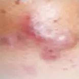 战痘总结,战痘十年是什么样子