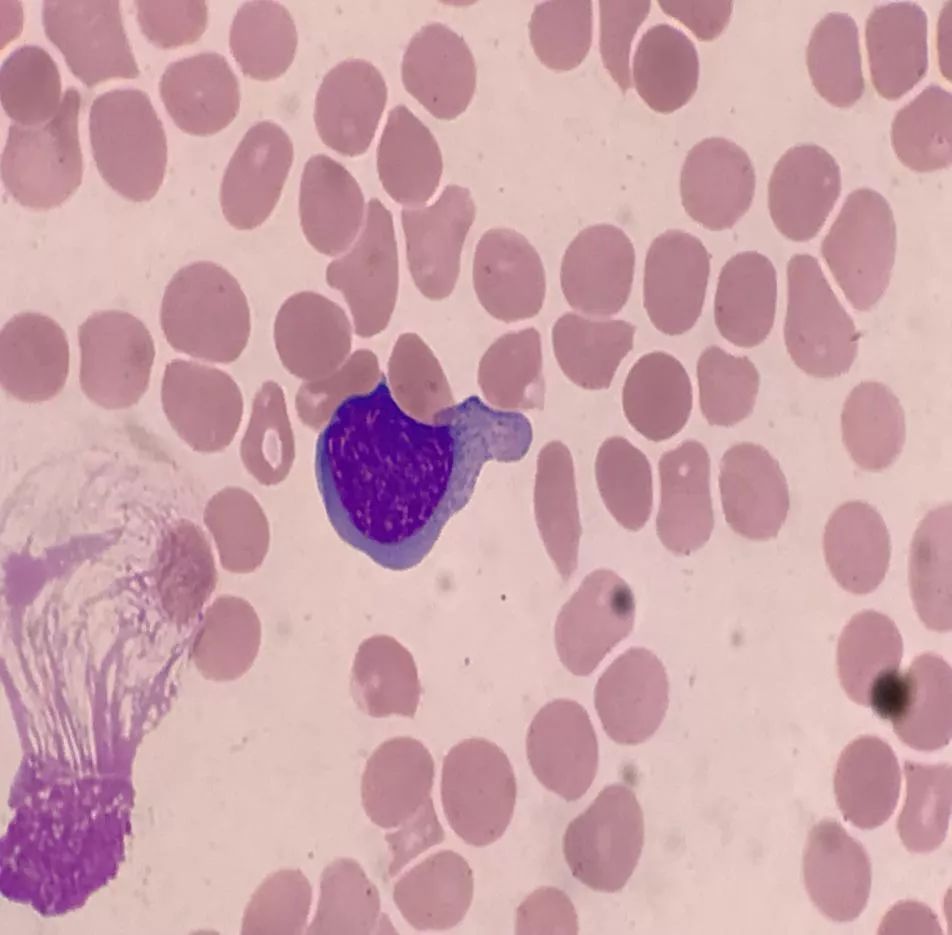 套细胞淋巴瘤胸腔侵润病例分享