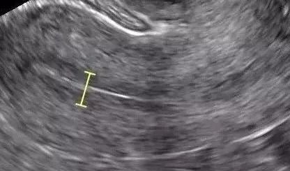 子宫内膜为什么不完全覆盖基底层,子宫内膜分型标准