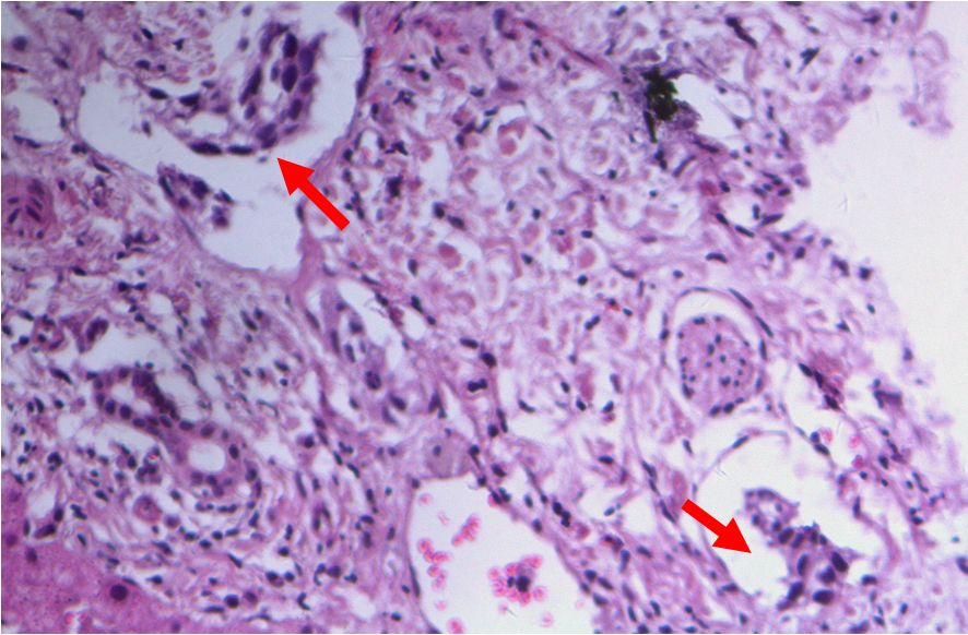 alp和ggt偏高是什么意思,alp和ggt下降意味着什么