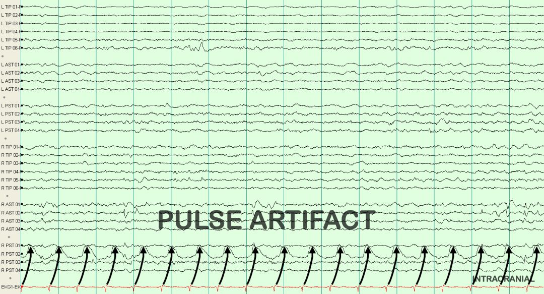 脑电图伪差图,脑电图伪差图谱
