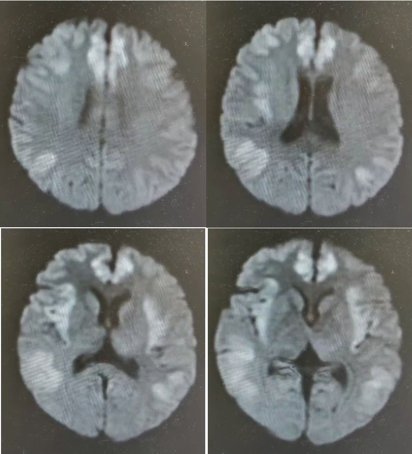 高氨血症有哪些表现,高氨血症