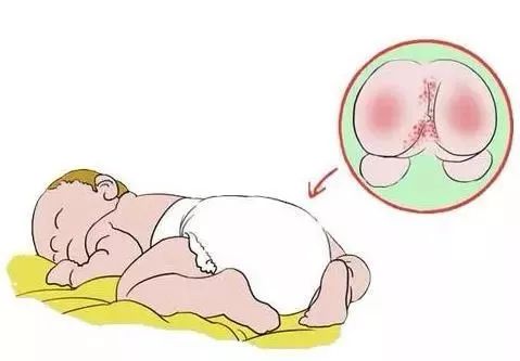 宝宝湿疹越来越多怎么办啊,宝宝湿疹怎么办5招教你轻松解决