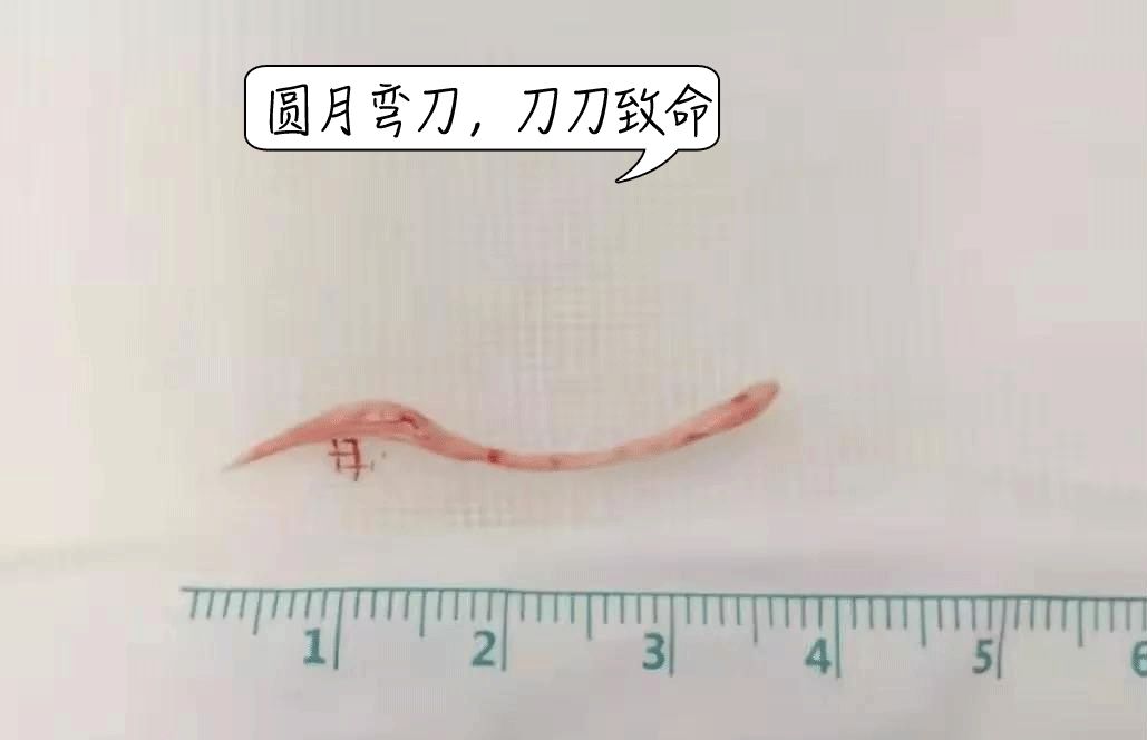 鱼刺卡住喉咙吞饭引危险,吃鱼吞了一根鱼刺开胸手术