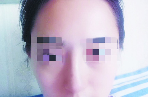 女子隆鼻花了七万没变,女子隆鼻失败要求免费修复被拒绝