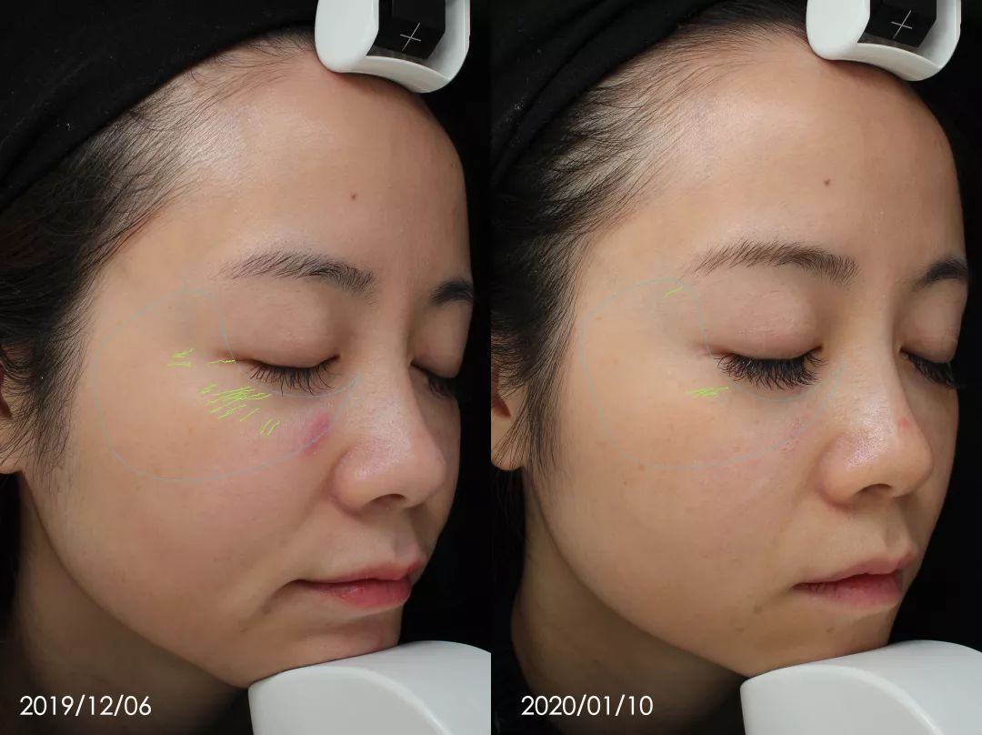 抗老三部曲紧致少女肌,抗老做好这五步hold住童颜少女肌