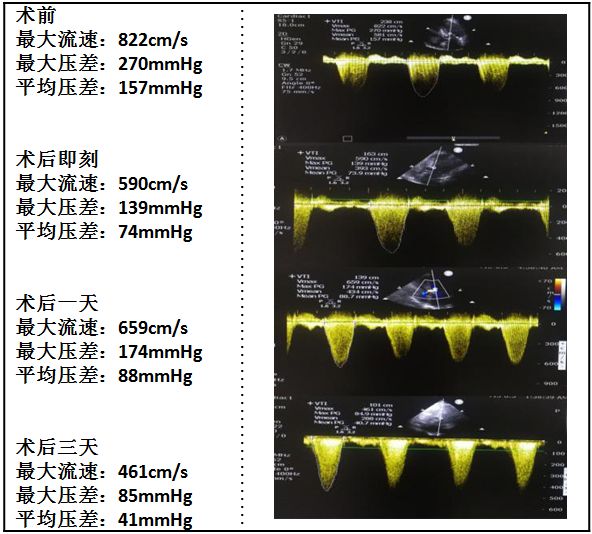 扩张型心肌病用什么消融,梗阻性肥厚性心肌病开胸手术恢复