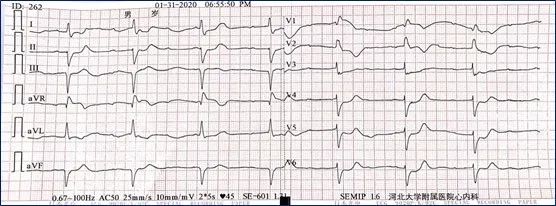 一度房室传导阻滞是怎么得的,三度房室传导阻滞最简单看法