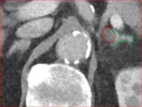 在线心内会诊室丨原醛治疗,“柳暗花明又一村”
