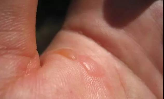 儿童开水烫伤急救处理,被开水烫伤怎么办最快最有效