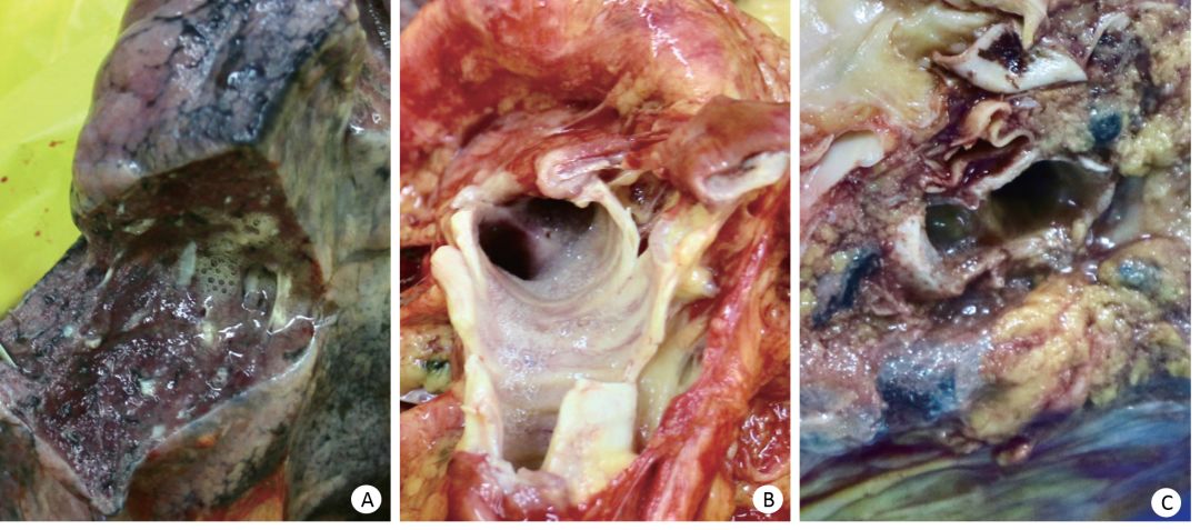 新冠气道炎症分泌物多,新冠肺炎呼吸道分泌物的处理
