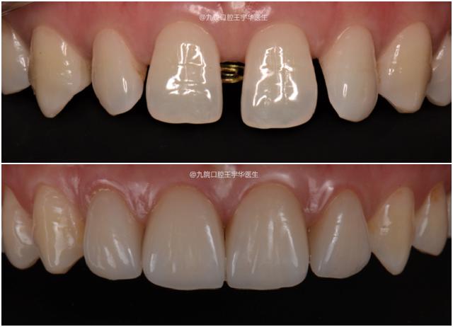 门牙中间有缝是否影响运势,门牙开缝是不是很丑
