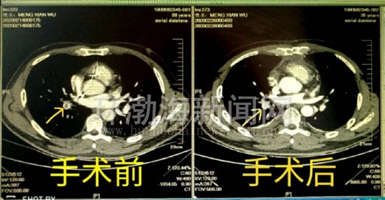 唐山工人医院治疗肺栓塞费用,唐山工人医院做心脏导管手术