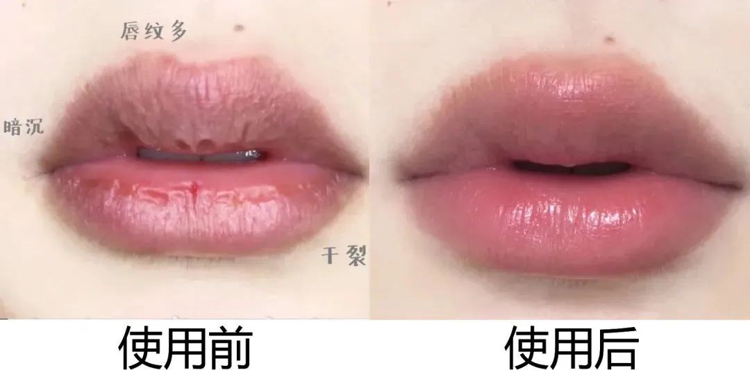 嘴唇干裂起皮等皮掉了涂唇膏,嘴唇干脱皮用什么唇部护理比较好?