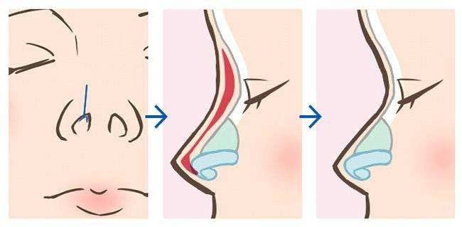 鼻炎手术可以和隆鼻一起吗,鼻炎影响鼻梁的发育吗