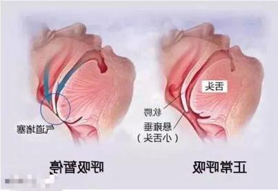 打鼾≠睡的香，多半人是这种病，得治！