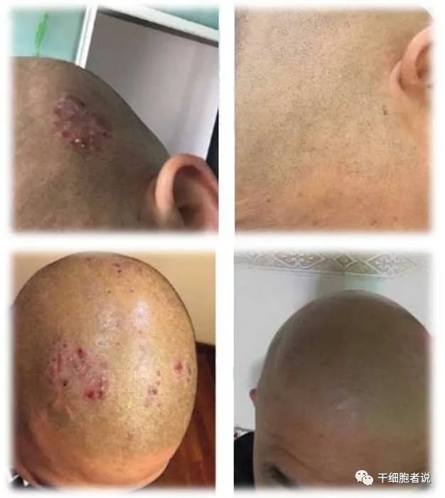 间充质干细胞治疗银屑病最新消息,间充质干细胞与类风湿性关节炎