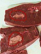 超声聚焦消融治疗肿瘤视频,高强度聚焦超声热消融肿瘤治疗