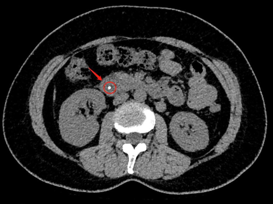 女人体内查出活虫只因一个菜,女子爱吃这道菜体内取出活虫