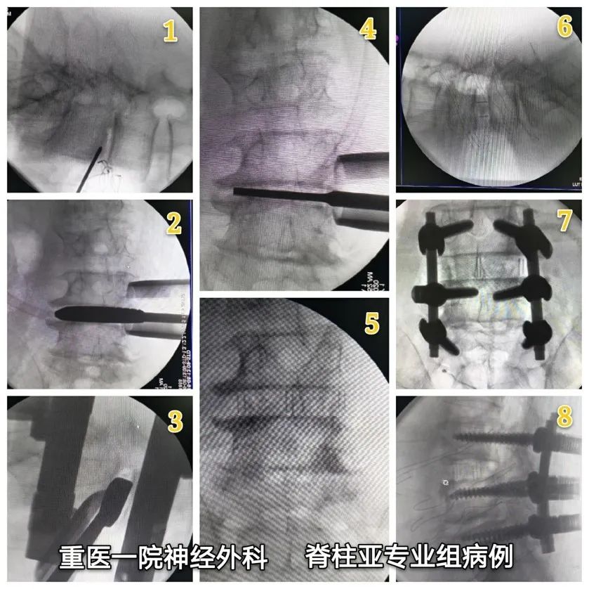 l4l5妞庝綋杞诲害婊戣劚鎬庝箞娌荤枟,l4l5鑵版婊戣劚