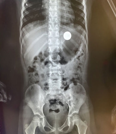 1岁小孩误吞硬币医生一秒取出,6岁孩子误吞硬币一周后才发现