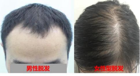 华西专家说，比悲伤更悲伤的事是：仙女们满脸胶原蛋白，但是头，秃了……