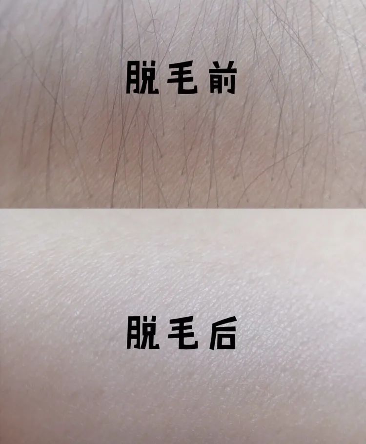光滑无暇|黑丑的“毛裤腿”，用它，10分钟“脱”得一干二净，肌肤光滑细腻