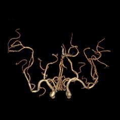 左侧大脑后动脉开窗畸形图片,脑部基底动脉开窗畸形如何治疗