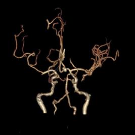 左侧大脑后动脉开窗畸形图片,脑部基底动脉开窗畸形如何治疗