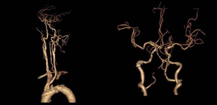 左侧大脑后动脉开窗畸形图片,脑部基底动脉开窗畸形如何治疗