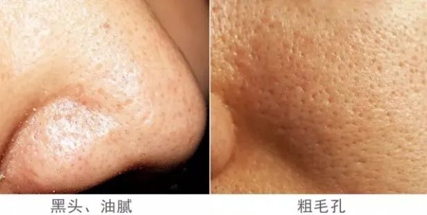 洗出脸上的脏东西解压,清除脸上斑块的产品