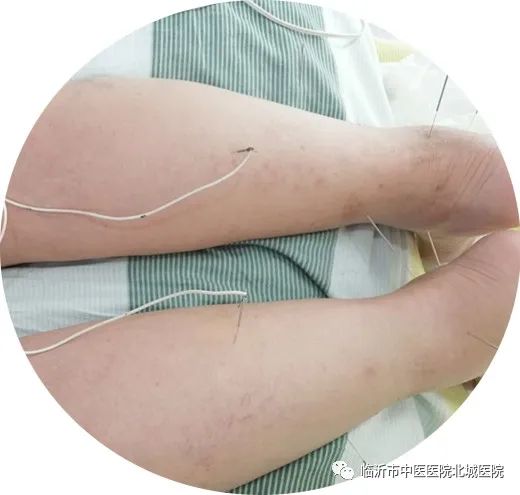 不用住院，医保报销！临沂这家医院的“中医日间病房”太赞了