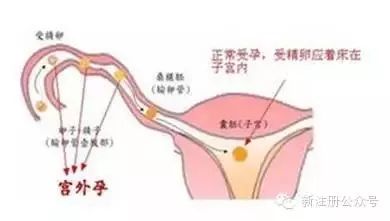 早孕少量见红有事么,早孕见红怎么办