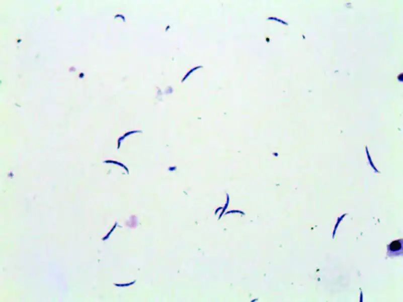 尿液中有肉眼可见杂质正常吗,尿液有形成分检查细菌偏高